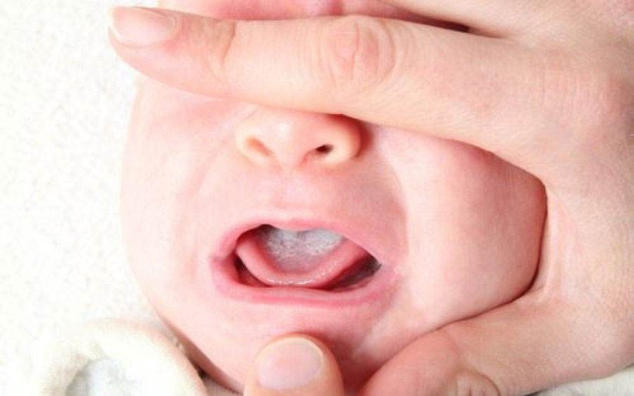 giảm tưa lưỡi ở trẻ sơ sinh